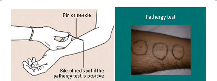 Hình ảnh test Pathergy ở bệnh nhân Behcet